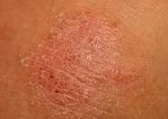 Image result for Bed Bug Bites Groin