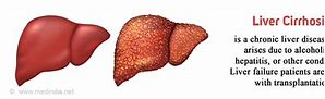 Image result for Early Symptoms Cirrhosis Liver