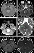 Image result for Medulloblastoma in Child