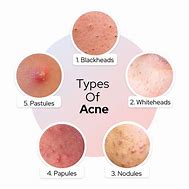 Image result for Pustules and Papules On Face