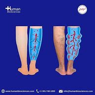 Image result for Vasculitis Leg Ulcers