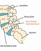 Image result for Pars Defect Lumbar Spine