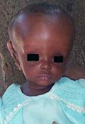 Image result for Hydrocephalus