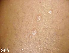 Image result for Plane Warts