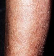 Image result for Thickened Skin On Lower Legs