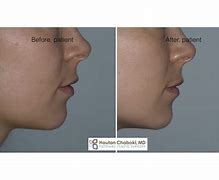 Image result for Middle Chin Dimple