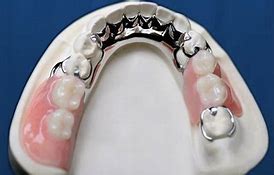 Image result for Partial Plate Dentures