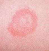 Image result for Small Red Circular Rash On Skin