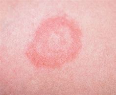 Image result for Circular Rash On Skin