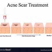 Image result for Atrophic Scar Treatment