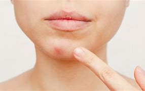 Image result for Acne Under Chin