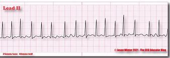 Image result for Atrial Fibrillation On the Body