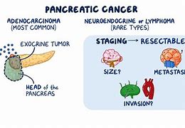 Image result for Pancreatic Adenocarcinoma