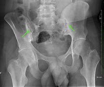 Image result for Hip Joint Space Narrowing