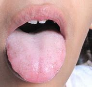 Image result for White Tongue Coating Candida