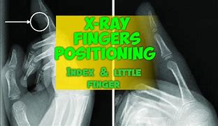 Image result for PA Finger X-ray