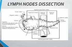 Image result for Whipple Specimen Gross Pathology