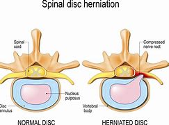 Image result for Lumbar Spine Herniation