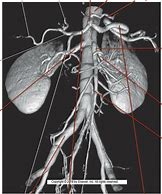 Image result for CT Angiogram Abdomen