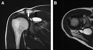 Image result for Shoulder MRI