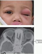 Image result for Subperiosteal Abscess Orbital Cellulitis