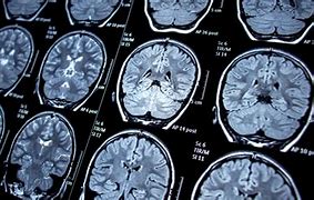 Image result for Brain Cancer Photo Human