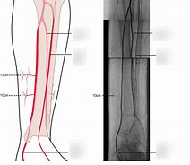 Image result for Lower Leg Artery