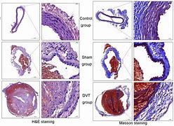 Image result for Thrombosis Histology