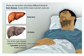 Image result for Early Symptoms Cirrhosis Liver