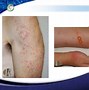 Image result for Fungi Bites and Stings