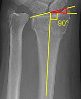 Image result for Radius Fracture