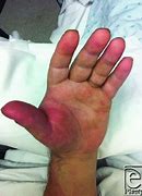 Image result for Cat Bite On Finger