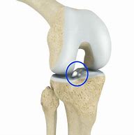 Image result for Posterior Knee Loose Bodies