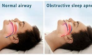 Image result for Obstructive Sleep Apnea Machine