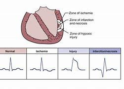 Image result for Acral Ischemia