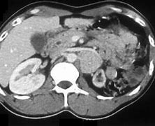 Image result for Large Pheochromocytoma CT