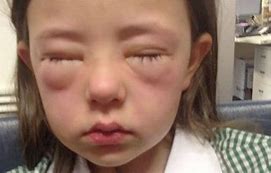 Image result for Peanut Butter Allergic Reaction