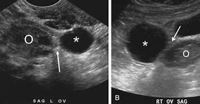 Image result for Fallopian Tube Ectopic Pregnancy Ultrasound