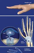 Image result for Ganglion Cyst in Capitate