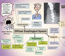 Image result for Esophageal Sphincter Spasm