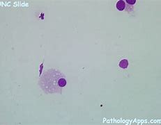 Image result for Adrenal Cytology