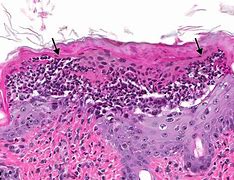 Image result for Pustule Skin Lesion