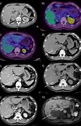 Image result for Large Pheochromocytoma CT