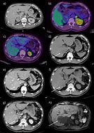 Image result for Pheochromocytoma CT Abdomen