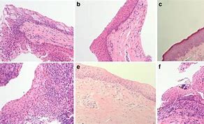 Image result for Punctal Stenosis