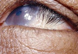 Image result for Trichiniasis