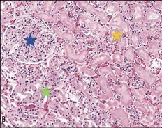 Image result for Necrosis Histology