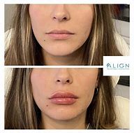 Image result for Versa Lip Filler