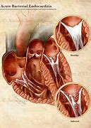 Image result for Acute Endocarditis