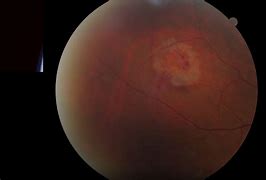 Image result for Damaged Retina